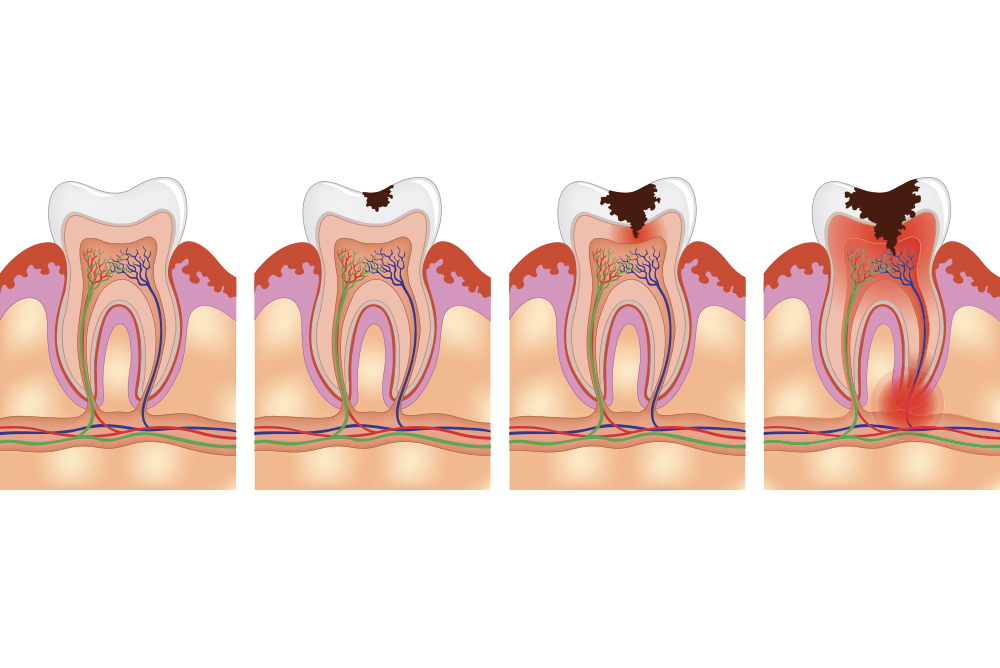 Conservativa - Studio dentistico associato Cerri