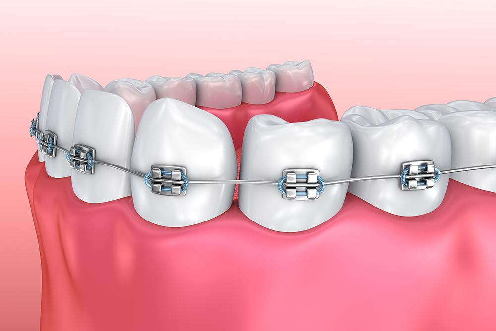 Ortodonzia - Studio dentistico associato Cerri