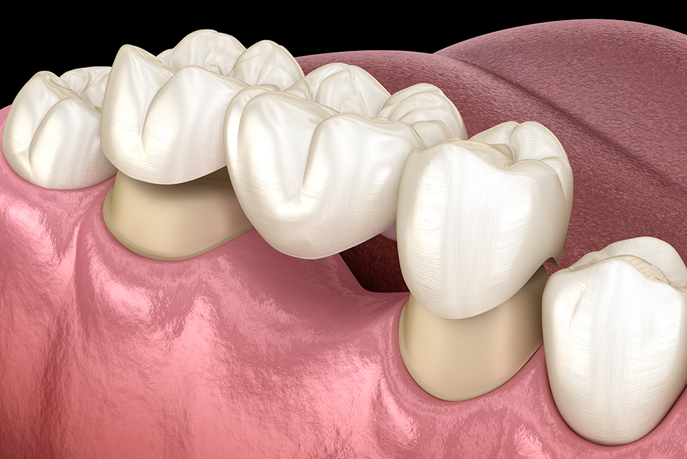 Protesi - Studio dentistico associato Cerri